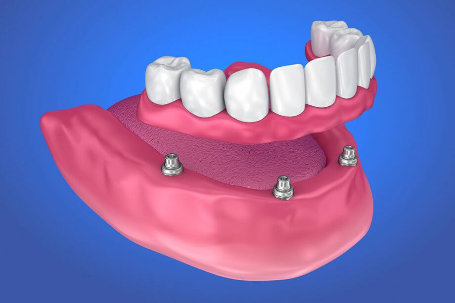 Implant Dentures - Missing Teeth - Dental Wellness of Lexington